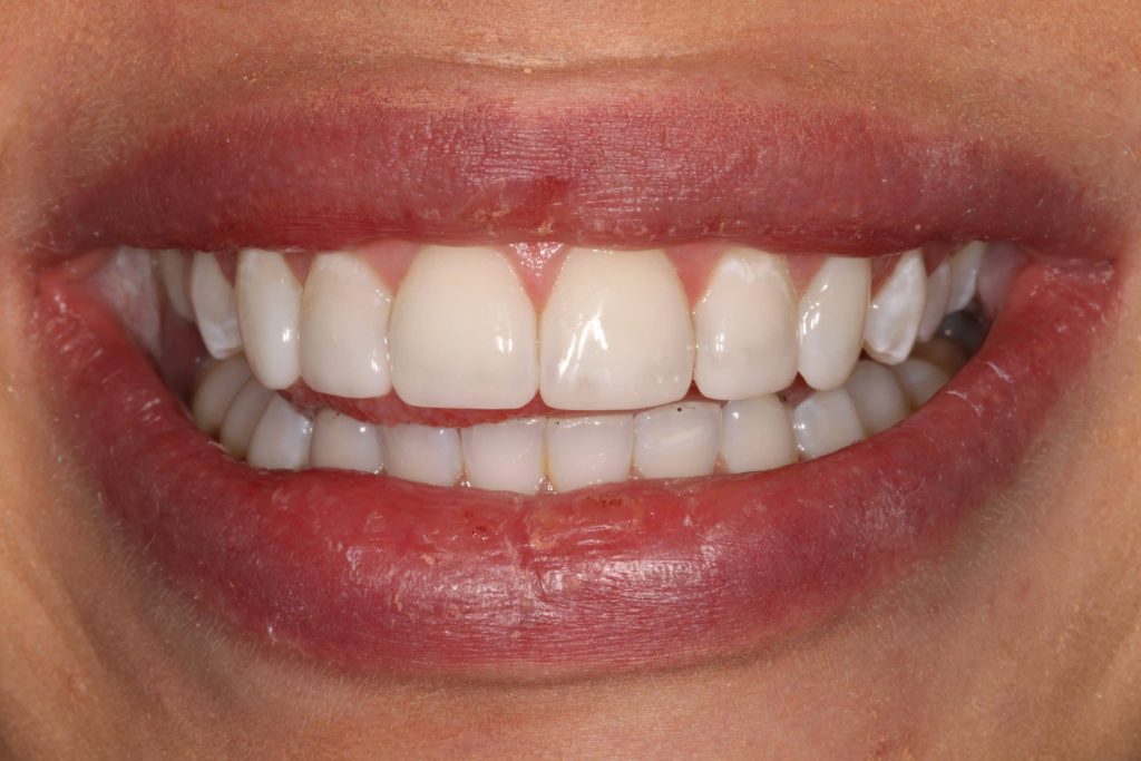Composite Bonding: Redefining Dental Texture for Natural Smiles