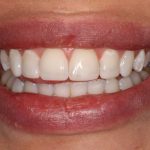 Composite Bonding: Redefining Dental Texture for Natural Smiles