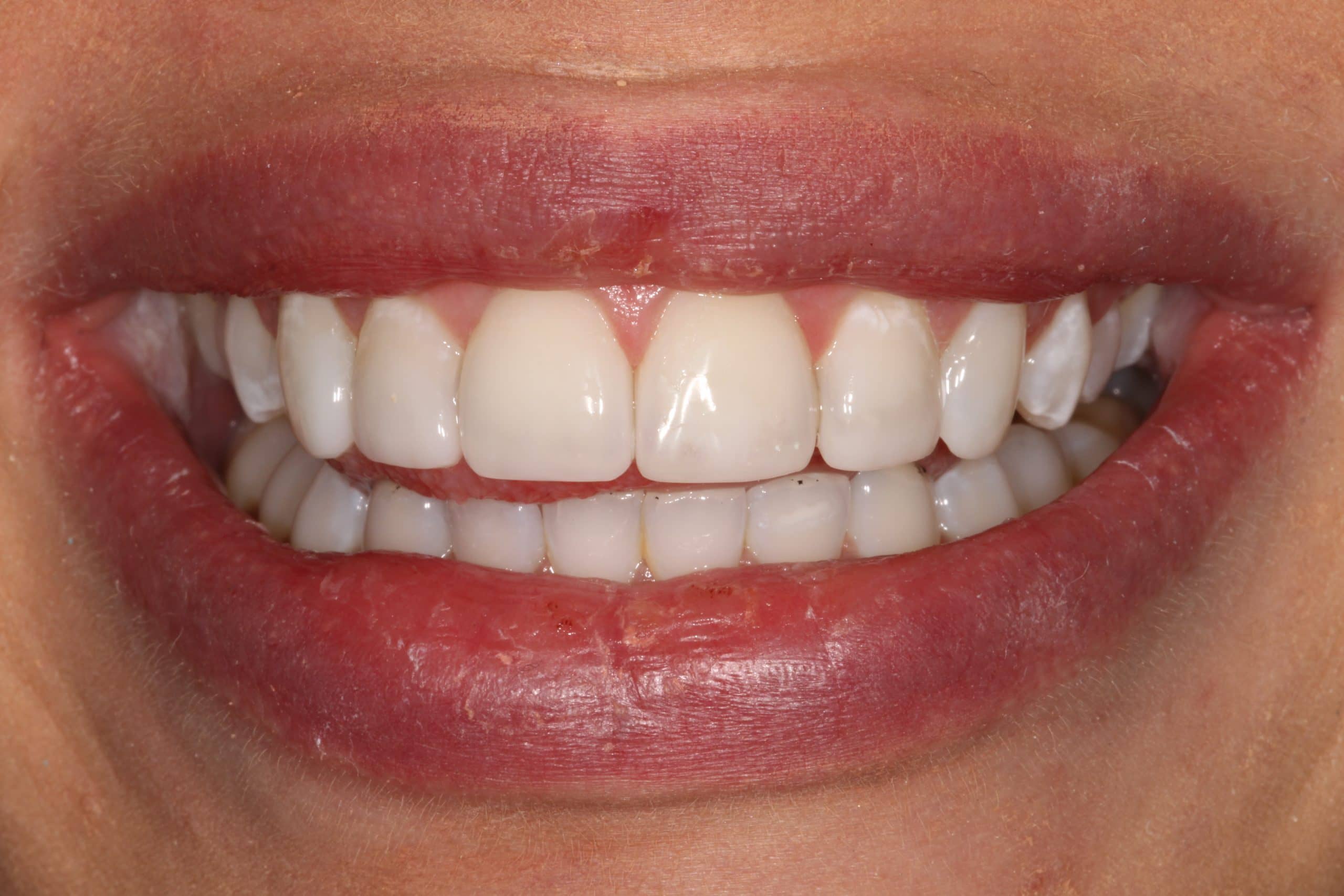 Composite Bonding: Redefining Dental Texture for Natural Smiles